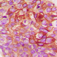 SRC Antibody - Immunohistochemical analysis of c-SRC staining in human breast cancer formalin fixed paraffin embedded tissue section. The section was pre-treated using heat mediated antigen retrieval with sodium citrate buffer (pH 6.0). The section was then incubated with the antibody at room temperature and detected using an HRP conjugated compact polymer system. DAB was used as the chromogen. The section was then counterstained with hematoxylin and mounted with DPX.