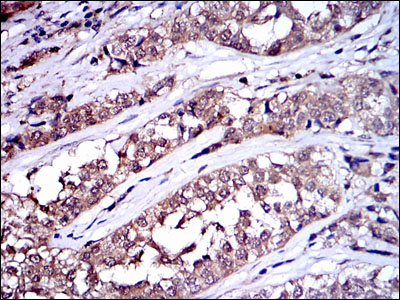 SRC Antibody - IHC of paraffin-embedded bladder cancer tissues using SRC mouse monoclonal antibody with DAB staining.