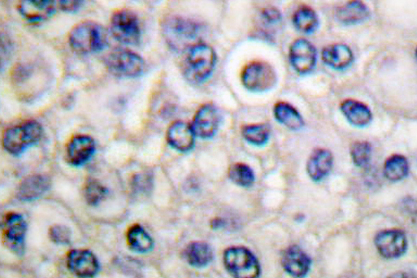 SRC Antibody - IHC of c-Src (A420)pAb in paraffin-embedded breast carcinoma tissue.