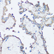 SRC Antibody - Immunohistochemistry of paraffin-embedded human lung cancer using SRC antibody at dilution of 1:100 (40x lens).