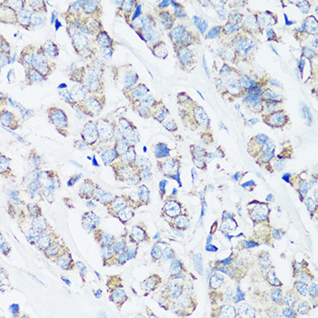 SRC Antibody - Immunohistochemistry of paraffin-embedded human breast cancer using SRC antibody at dilution of 1:100 (40x lens).