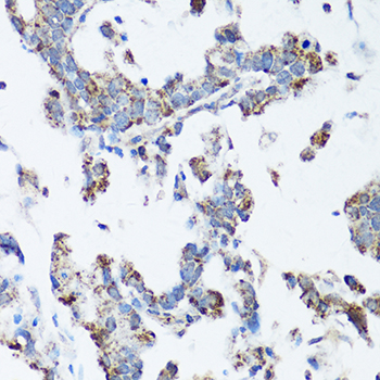 SRC Antibody - Immunohistochemistry of paraffin-embedded human gastric cancer using SRC antibody at dilution of 1:100 (40x lens).