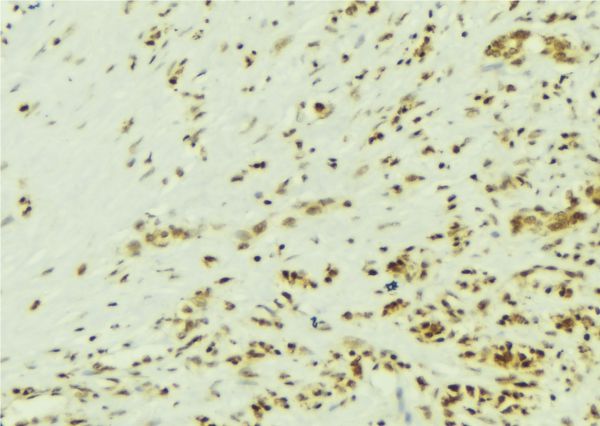 SRC Antibody - 1:100 staining human breast carcinoma tissue by IHC-P. The sample was formaldehyde fixed and a heat mediated antigen retrieval step in citrate buffer was performed. The sample was then blocked and incubated with the antibody for 1.5 hours at 22°C. An HRP conjugated goat anti-rabbit antibody was used as the secondary.