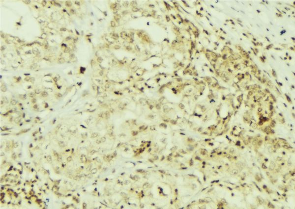 SRC Antibody - 1:100 staining human breast carcinoma tissue by IHC-P. The sample was formaldehyde fixed and a heat mediated antigen retrieval step in citrate buffer was performed. The sample was then blocked and incubated with the antibody for 1.5 hours at 22°C. An HRP conjugated goat anti-rabbit antibody was used as the secondary.