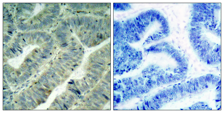 SRC Antibody - Immunohistochemistry analysis of paraffin-embedded human colon carcinoma, using Src (Phospho-Tyr418) Antibody. The picture on the right is blocked with the phospho peptide.