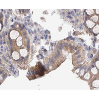 SRC Antibody - 1:200 staining human colon carcinoma tissue by IHC-P. The tissue was formaldehyde fixed and a heat mediated antigen retrieval step in citrate buffer was performed. The tissue was then blocked and incubated with the antibody for 1.5 hours at 22°C. An HRP conjugated goat anti-rabbit antibody was used as the secondary.