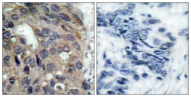 SRC Antibody - Immunohistochemistry analysis of paraffin-embedded human breast carcinoma, using Src (Phospho-Tyr529) Antibody. The picture on the right is blocked with the phospho peptide.