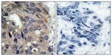 SRC Antibody - Immunohistochemistry analysis of paraffin-embedded human breast carcinoma, using Src (Phospho-Tyr529) Antibody. The picture on the right is blocked with the phospho peptide.
