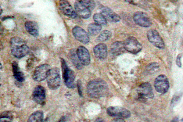 SRC Antibody - IHC of p-c-Src (Y529) pAb in paraffin-embedded human breast carcinoma tissue.
