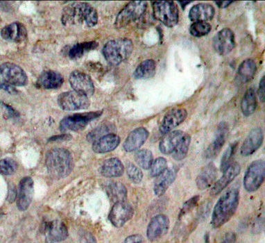 SRC Antibody - Immunohistochemical analysis of paraffin-embedded human breast carcinoma tissue.