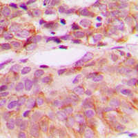 SRC Antibody - Immunohistochemical analysis of c-SRC (pY529) staining in human breast cancer formalin fixed paraffin embedded tissue section. The section was pre-treated using heat mediated antigen retrieval with sodium citrate buffer (pH 6.0). The section was then incubated with the antibody at room temperature and detected using an HRP conjugated compact polymer system. DAB was used as the chromogen. The section was then counterstained with hematoxylin and mounted with DPX.