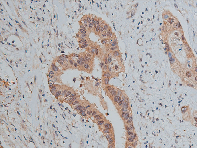 SRC Antibody - 1:50 staining human colon carcinoma tissue by IHC-P. The tissue was formaldehyde fixed and a heat mediated antigen retrieval step in citrate buffer was performed. The tissue was then blocked and incubated with the antibody for 1.5 hours at 22°C. An HRP conjugated goat anti-rabbit antibody was used as the secondary.