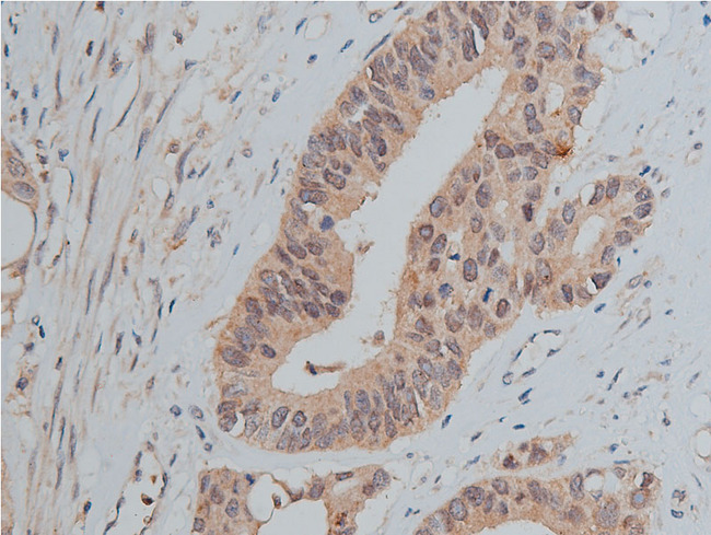 SRC Antibody - 1:50 staining human colon carcinoma tissue by IHC-P. The tissue was formaldehyde fixed and a heat mediated antigen retrieval step in citrate buffer was performed. The tissue was then blocked and incubated with the antibody for 1.5 hours at 22°C. An HRP conjugated goat anti-rabbit antibody was used as the secondary.