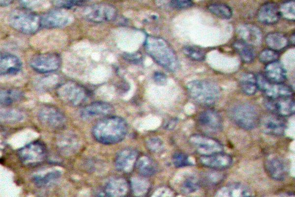 SRC Antibody - IHC of c-Src (T523) pAb in paraffin-embedded human breast carcinoma tissue.