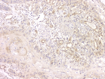 SRCIN1 / SNIP Antibody - IHC staining of FFPE human esophageal squamous cancer with SRCIN1 antibody at 1ug/ml. HIER: boil tissue sections in pH6, 10mM citrate buffer, for 10-20 min and allow to cool before testing.