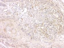 SRCIN1 / SNIP Antibody - IHC staining of FFPE human esophageal squamous cancer with SRCIN1 antibody at 1ug/ml. HIER: boil tissue sections in pH6, 10mM citrate buffer, for 10-20 min and allow to cool before testing.