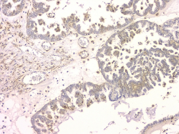 SRCIN1 / SNIP Antibody - IHC staining of FFPE human ovarian cancer with SRCIN1 antibody at 1ug/ml. HIER: boil tissue sections in pH6, 10mM citrate buffer, for 10-20 min and allow to cool before testing.