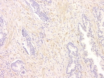 SRCIN1 / SNIP Antibody - IHC staining of FFPE human ovarian cancer with SRCIN1 antibody at 1ug/ml. HIER: boil tissue sections in pH6, 10mM citrate buffer, for 10-20 min and allow to cool before testing.