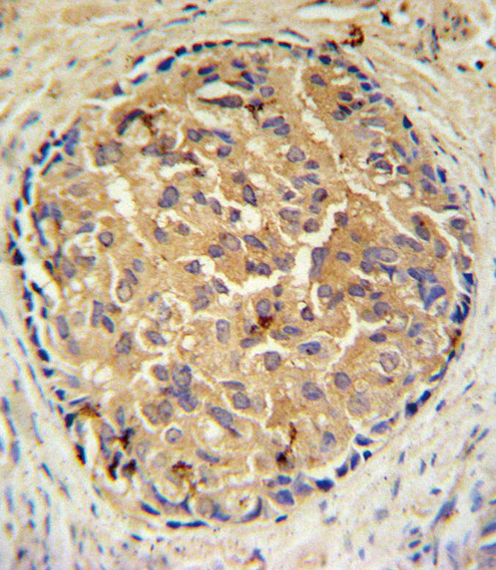SRD5A2L / SRD5A3 Antibody - SRD5A3 Antibody IHC of formalin-fixed and paraffin-embedded human prostate carcinoma followed by peroxidase-conjugated secondary antibody and DAB staining.