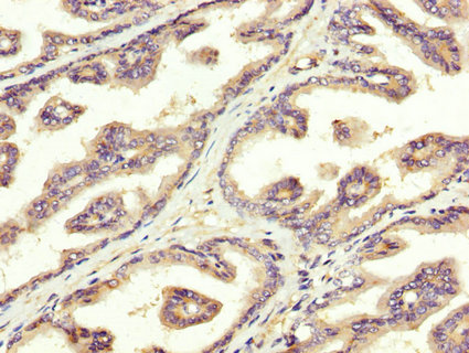 SREBF1 / SREBP-1 Antibody - Immunohistochemistry image at a dilution of 1:300 and staining in paraffin-embedded human prostate tissue performed on a Leica BondTM system. After dewaxing and hydration, antigen retrieval was mediated by high pressure in a citrate buffer (pH 6.0) . Section was blocked with 10% normal goat serum 30min at RT. Then primary antibody (1% BSA) was incubated at 4 °C overnight. The primary is detected by a biotinylated secondary antibody and visualized using an HRP conjugated SP system.