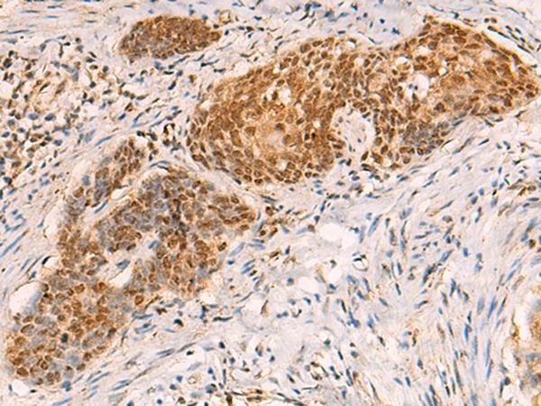 SREBF2 / SREBP2 Antibody - Immunohistochemistry of paraffin-embedded Human esophagus cancer tissue  using SREBF2 Polyclonal Antibody at dilution of 1:50(×200)