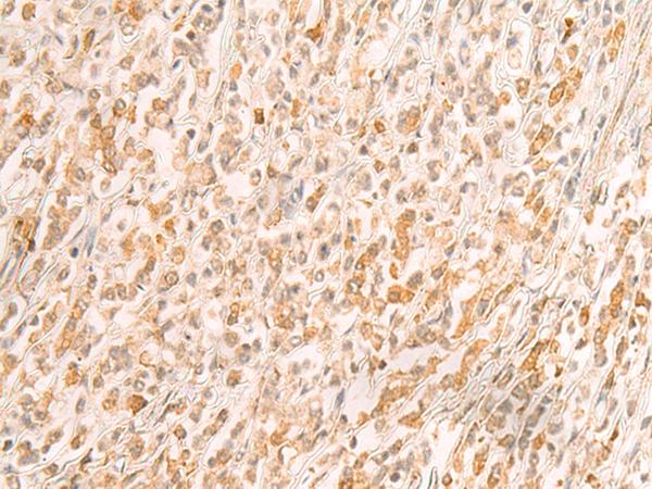 SREBF2 / SREBP2 Antibody - Immunohistochemistry of paraffin-embedded Human gastric cancer tissue  using SREBF2 Polyclonal Antibody at dilution of 1:50(×200)