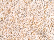 SREBF2 / SREBP2 Antibody - Immunohistochemistry of paraffin-embedded Human gastric cancer tissue  using SREBF2 Polyclonal Antibody at dilution of 1:50(×200)