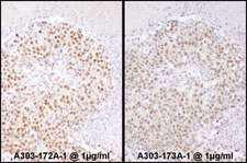 SRF / Serum Response Factor Antibody - Detection of Human SRF by Immunohistochemistry. Samples: FFPE sections of human ovarian carcinoma. Antibody: Affinity purified rabbit anti-SRF Lot1 used at a dilution of 1:1000 (1 ug/ml) (left). Detection: DAB.