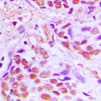 SRF / Serum Response Factor Antibody - Immunohistochemical analysis of SRF staining in human breast cancer formalin fixed paraffin embedded tissue section. The section was pre-treated using heat mediated antigen retrieval with sodium citrate buffer (pH 6.0). The section was then incubated with the antibody at room temperature and detected using an HRP conjugated compact polymer system. DAB was used as the chromogen. The section was then counterstained with hematoxylin and mounted with DPX.
