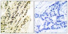 SRF / Serum Response Factor Antibody - Peptide - + Immunohistochemical analysis of paraffin-embedded human breast carcinoma tissue using SRF (Ab-99) antibody.