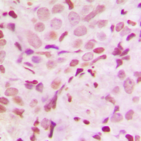 SRF / Serum Response Factor Antibody - Immunohistochemical analysis of SRF (pS103) staining in human breast cancer formalin fixed paraffin embedded tissue section. The section was pre-treated using heat mediated antigen retrieval with sodium citrate buffer (pH 6.0). The section was then incubated with the antibody at room temperature and detected using an HRP-conjugated compact polymer system. DAB was used as the chromogen. The section was then counterstained with hematoxylin and mounted with DPX.