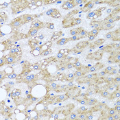 SRI / Sorcin Antibody - Immunohistochemistry of paraffin-embedded human liver injury tissue.