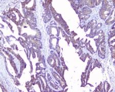 SRI / Sorcin Antibody - IHC staining of FFPE human intestinal cancer with SRI antibody at 1ug/ml. HIER: boil tissue sections in pH6, 10mM citrate buffer, for 10-20 min followed by cooling at RT for 20 min.