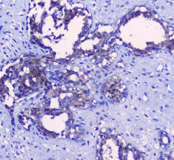 SRI / Sorcin Antibody - IHC staining of FFPE human breast cancer with SRI antibody at 1ug/ml. HIER: boil tissue sections in pH6, 10mM citrate buffer, for 10-20 min followed by cooling at RT for 20 min.