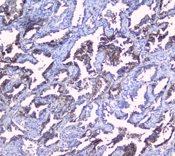 SRI / Sorcin Antibody - IHC staining of FFPE human lung cancer with SRI antibody at 1ug/ml. HIER: boil tissue sections in pH6, 10mM citrate buffer, for 10-20 min followed by cooling at RT for 20 min.