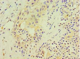 SRM / Spermidine Synthase Antibody - Immunohistochemistry of paraffin-embedded human breast cancer using antibody at 1:100 dilution.
