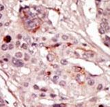 SRMS Antibody - Formalin-fixed and paraffin-embedded human cancer tissue reacted with the primary antibody, which was peroxidase-conjugated to the secondary antibody, followed by AEC staining. This data demonstrates the use of this antibody for immunohistochemistry; clinical relevance has not been evaluated. BC = breast carcinoma; HC = hepatocarcinoma.