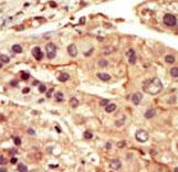 SRMS Antibody - Formalin-fixed and paraffin-embedded human cancer tissue reacted with the primary antibody, which was peroxidase-conjugated to the secondary antibody, followed by DAB staining. This data demonstrates the use of this antibody for immunohistochemistry; clinical relevance has not been evaluated. BC = breast carcinoma; HC = hepatocarcinoma.