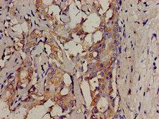 SRMS Antibody - Immunohistochemistry analysis of human breast cancer at a dilution of 1:100
