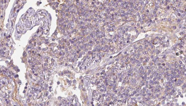 SRP14 Antibody - 1:100 staining human lymph carcinoma tissue by IHC-P. The sample was formaldehyde fixed and a heat mediated antigen retrieval step in citrate buffer was performed. The sample was then blocked and incubated with the antibody for 1.5 hours at 22°C. An HRP conjugated goat anti-rabbit antibody was used as the secondary.
