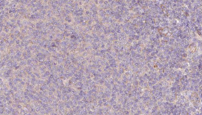 SRP9 Antibody - 1:100 staining human lymph carcinoma tissue by IHC-P. The sample was formaldehyde fixed and a heat mediated antigen retrieval step in citrate buffer was performed. The sample was then blocked and incubated with the antibody for 1.5 hours at 22°C. An HRP conjugated goat anti-rabbit antibody was used as the secondary.