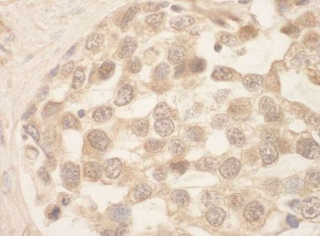 SRPK1 Antibody - Detection of Human SRPK1 by Immunohistochemistry. Sample: FFPE section of human seminoma. Antibody: Affinity purified rabbit anti-SRPK1 used at a dilution of 1:250.