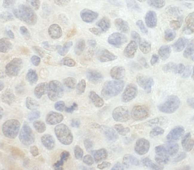 SRPK1 Antibody - Detection of Mouse SRPK1 by Immunohistochemistry. Sample: FFPE section of mouse CT26 tumor. Antibody: Affinity purified rabbit anti-SRPK1 used at a dilution of 1:250.