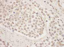 SRPK1 Antibody - Detection of Human SRPK1 by Immunohistochemistry. Sample: FFPE section of human testicular seminoma. Antibody: Affinity purified rabbit anti-SRPK1 used at a dilution of 1:200 (1 ug/ml). Detection: DAB.