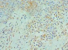 SRPK1 Antibody - Immunohistochemistry of paraffin-embedded human breast cancer using antibody at 1:100 dilution.