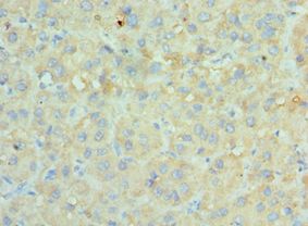 SRPK1 Antibody - Immunohistochemistry of paraffin-embedded human liver cancer using antibody at 1:100 dilution.