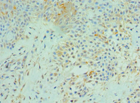 SRPK1 Antibody - Immunohistochemistry of paraffin-embedded human breast cancer using SRPK1 Antibody at dilution of 1:100