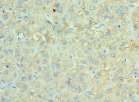 SRPK1 Antibody - Immunohistochemistry of paraffin-embedded human liver cancer using SRPK1 Antibody at dilution of 1:100