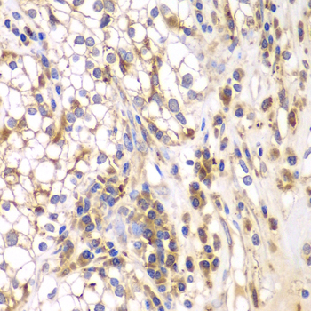 SRPK1 Antibody - Immunohistochemistry of paraffin-embedded human kidney cancer tissue.