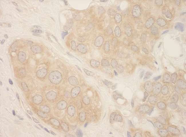 SRPK2 Antibody - Detection of Human SRPK2 by Immunohistochemistry. Sample: FFPE section of human breast carcinoma. Antibody: Affinity purified rabbit anti-SRPK2 used at a dilution of 1:250.